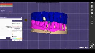 EXOCAD Bite Alignment Scan