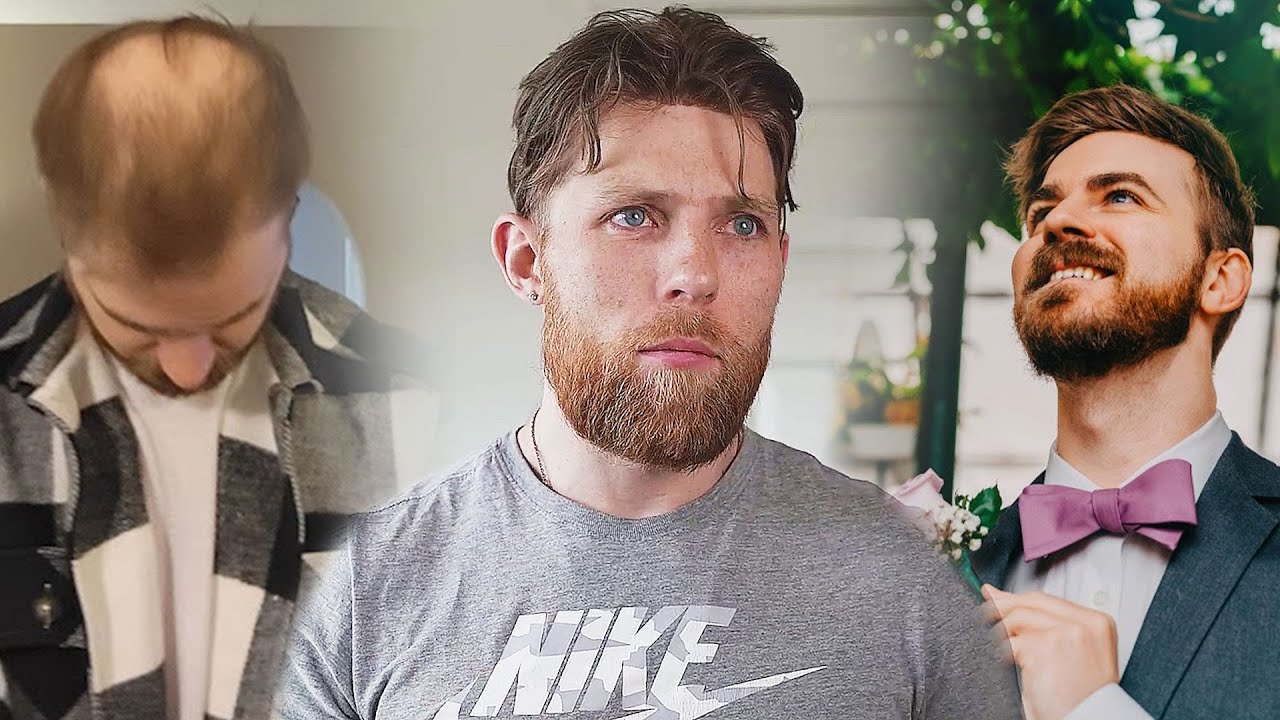 Kyle's Life Completely Changed The Moment He got A Hair System - Hair System Stories