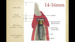 15. Considerations for the Use of Dental Implants With Removable Partial Dentures