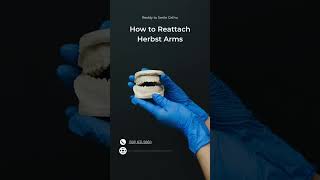 Herbst Appliance Arms Reattachment | Reddy to Smile Orthodontics