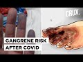 After Black Fungus, Doctors Detect Gangrene Cases In Covid-Recovered Patients In Mumbai