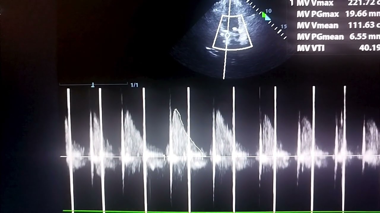 Prosthetic Mechanical Mitral Valve with Moderate stenosis with Rapid Atrial Fibrillation 