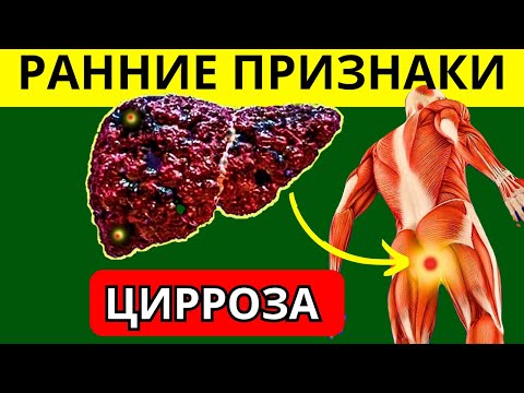 ВАША ПЕЧЕНЬ В ОПАСНОСТИ? 12 Ранних Признаков Цирроза Печени