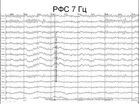 Пример нормальной ЭЭГ: как оценивать и что писать