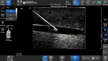 Venue™ Family R3 Tutorial - Needle Visualization