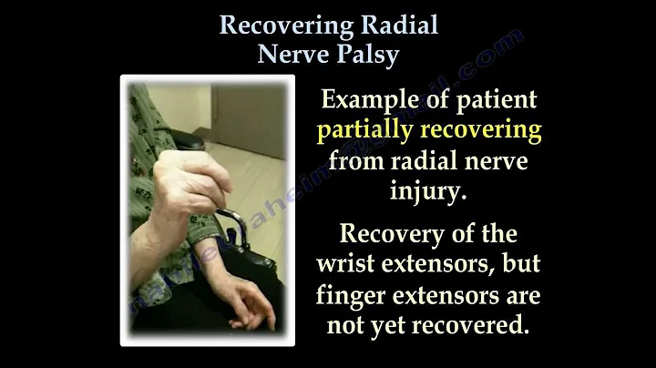 Radial Nerve Palsy ,Recovering . Part II- Everything You Need To Know - Dr. Nabil Ebraheim - DayDayNews