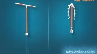 انیمیشن IUD دستگاه جلوگیری از بارداری