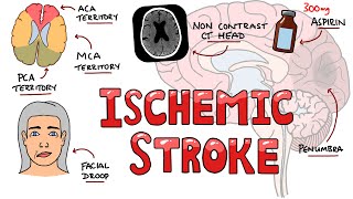 Acute Ischemic Stroke  Signs and Symptoms (Stroke Syndromes) | Causes & Mechanisms | Treatment