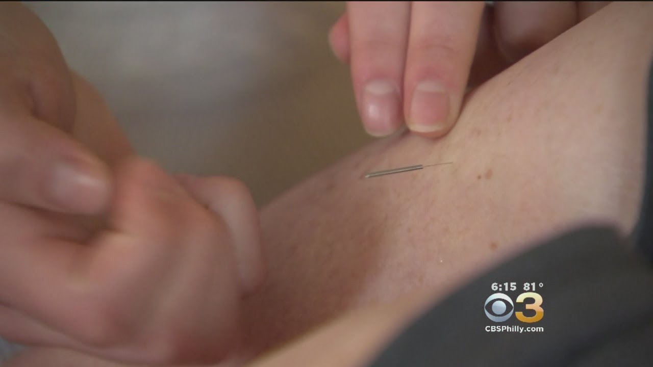 'Community Acupuncture' Making Waves Locally