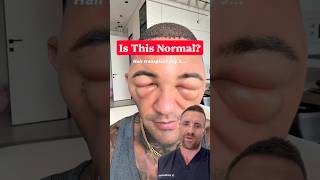 Why Does Your Face Swell After a Hair Transplant? #hairtransplant #hairlosstreatment #DrHopkirk