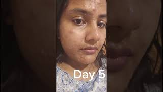 My Chickenpox Journey #healing #selfcare #alone #hard #tough #smile #food #shorts #kerala