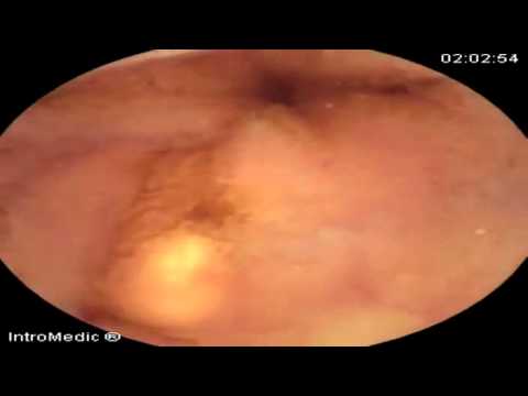 Small Bowel xanthoma viewed with MiroCam capsule endoscopy 