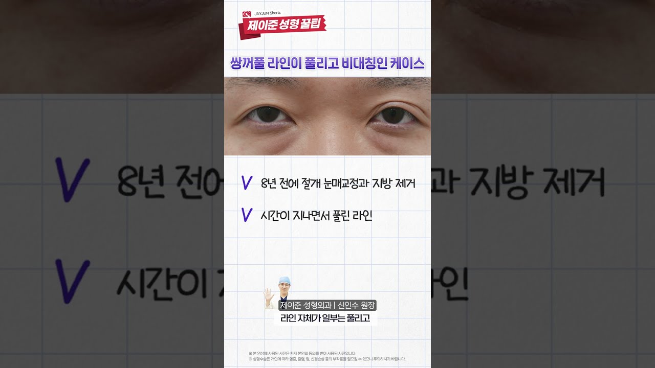 [JAYJUN Phẫu thuật thẩm mỹ Da] Mắt hai mí nam tái phẫu thuật đã hết lệch và nếp mí chồng chéo #shorts [Bí quyết JAYJUN]