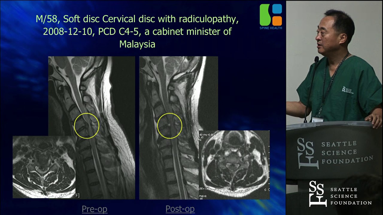 Endoscopic Cervical Procedures Gun Choi, MD, PhD YouTube