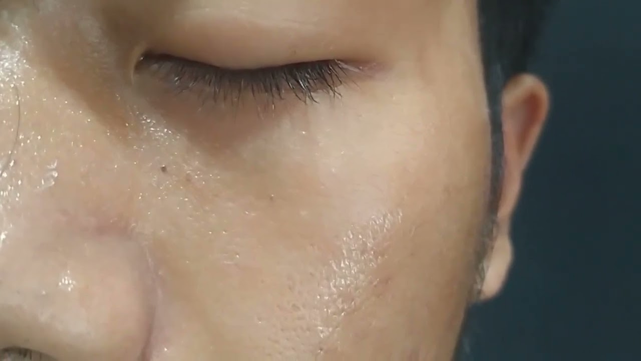 nose-skin-peeling-youtube