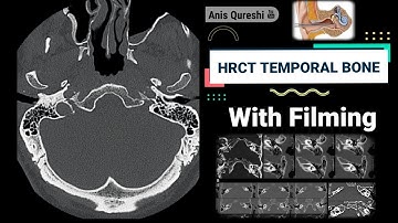 HRCT Temporal Bone with filming | By Anis Qureshi