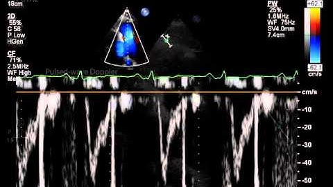 17. Measurement of acceleration time (for mPAP) at right ventricular outflow tract (RVOT)