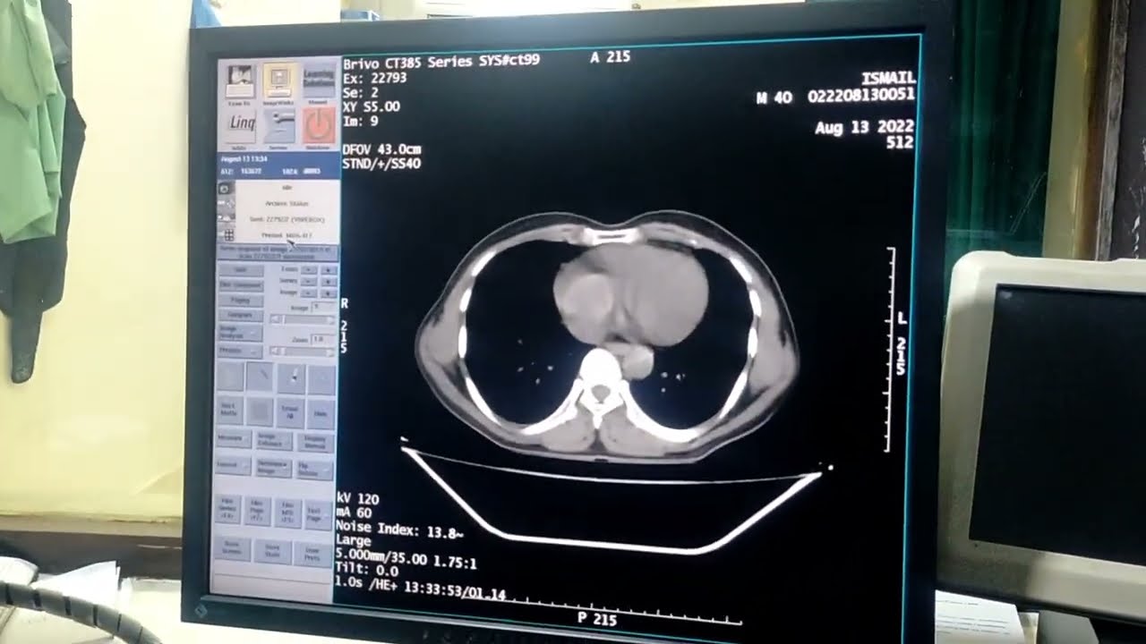 Live TPCT Abdomen On GE 16 Slice Scanner.