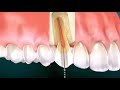 ¿Qué es la endodoncia y cómo se realiza?| Clínica Dental Más Bermejo Murcia