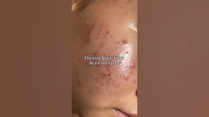 "Tiny Acne? Try This! | La Roche-Posay Effaclar Duo+ Review & How to Use" #acnes #acnefree #short