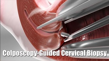 Het afnemen van afwijkend baarmoederhalsweefsel voor kanker