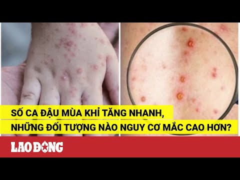 Video Số ca đậu mùa khỉ tăng nhanh, những đối tượng nào nguy... - YouTube