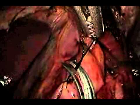 Video 4 - Toupet fundoplication