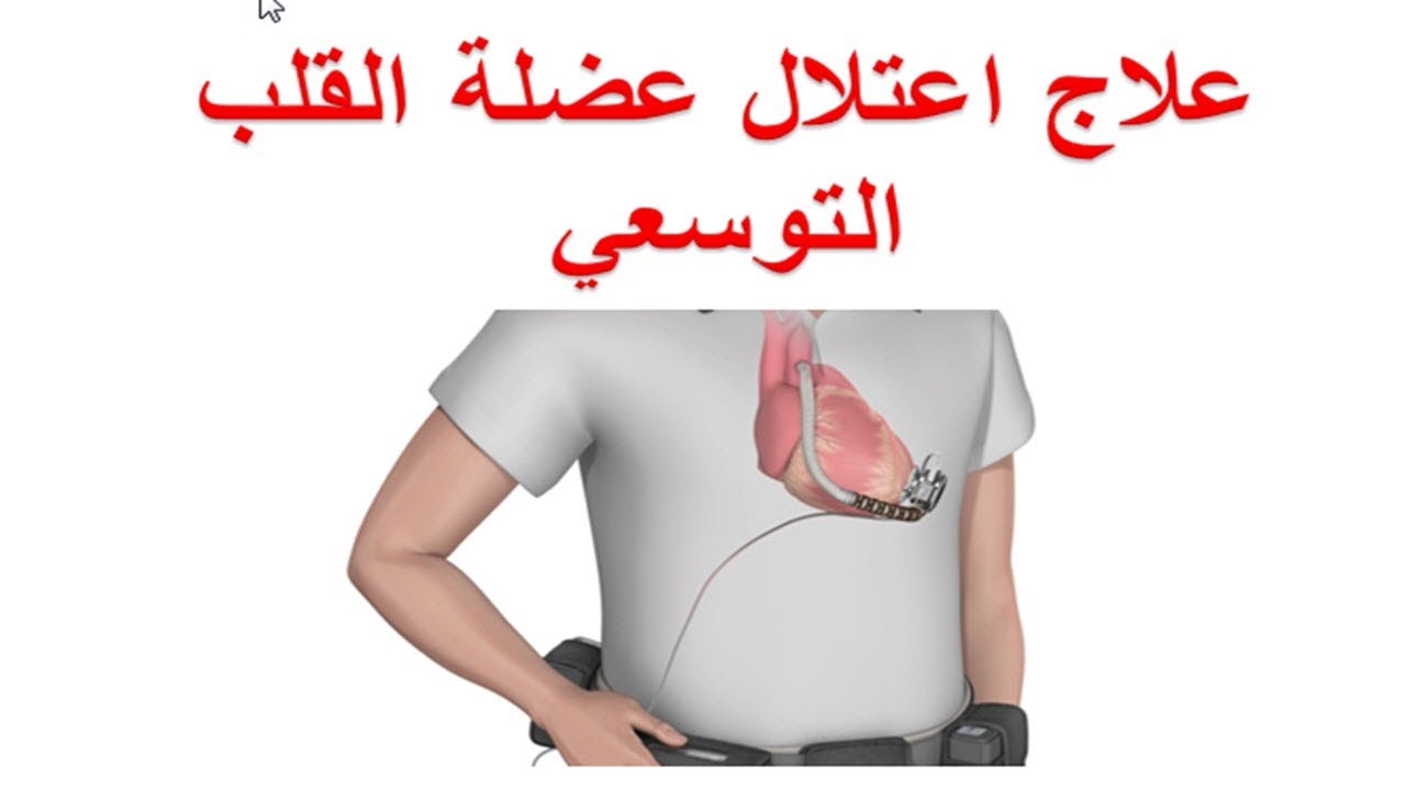 الطرق المختلفة لعلاج اعتلال عضلة القلب التوسعي