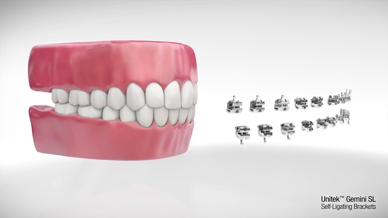 3M Unitek Gemini SL Self Ligating System | pinkblue - YouTube