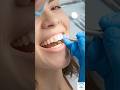 Dental Gem for Dazzling smile! Tooth Gem #dental#dentist#DentalGem#ToothGem#ToothJewelry#ViralShorts