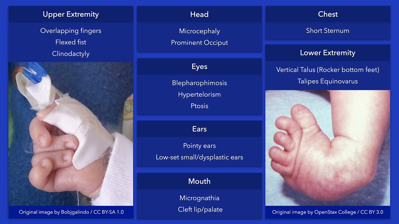 Trisomy 18 (Edward Syndrome) Dysmorphic Features YouTube