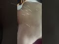 Acupuncture for upper back, neck and shoulders pain