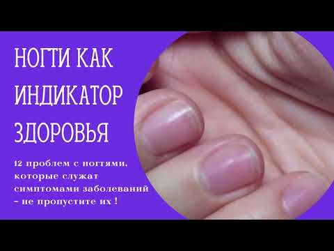 ⚠️КАК ПО НОГТЯМ ОПРЕДЕЛИТЬ ЗАБОЛЕВАНИЕ ОРГАНИЗМА. Что скрывается за проблемами с ногтями