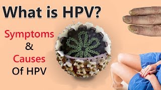Human Papillomavirus Infection Symptoms Causes Of Hpv