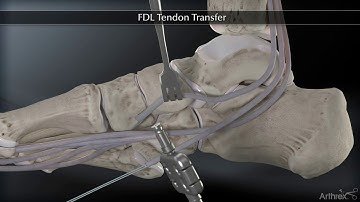 Flexor Digitorum Longus FDL Tendon Transfer