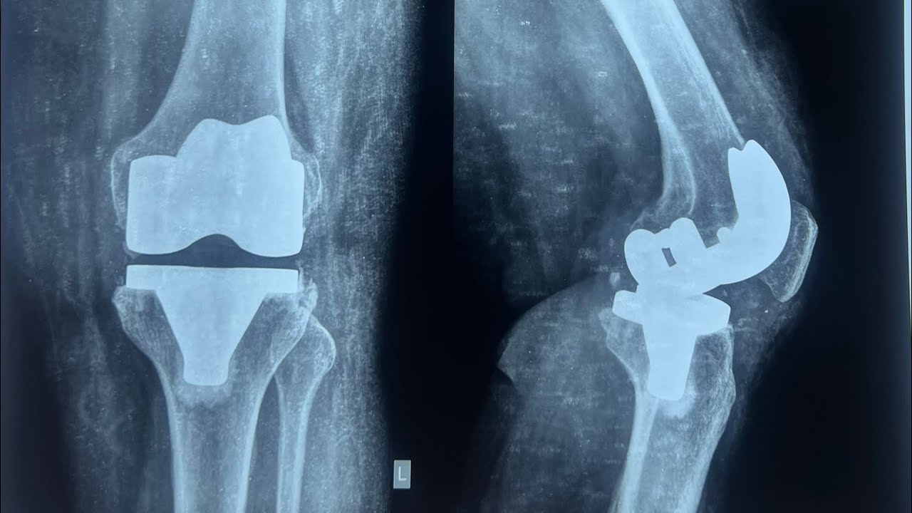 BILATERAL TOTAL KNEE REPLACEMENT - YouTube