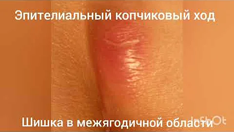 Шишка возле копчика. Шишка между ягодиц. Эпителиальный копчиковый ход. Киста копчика.