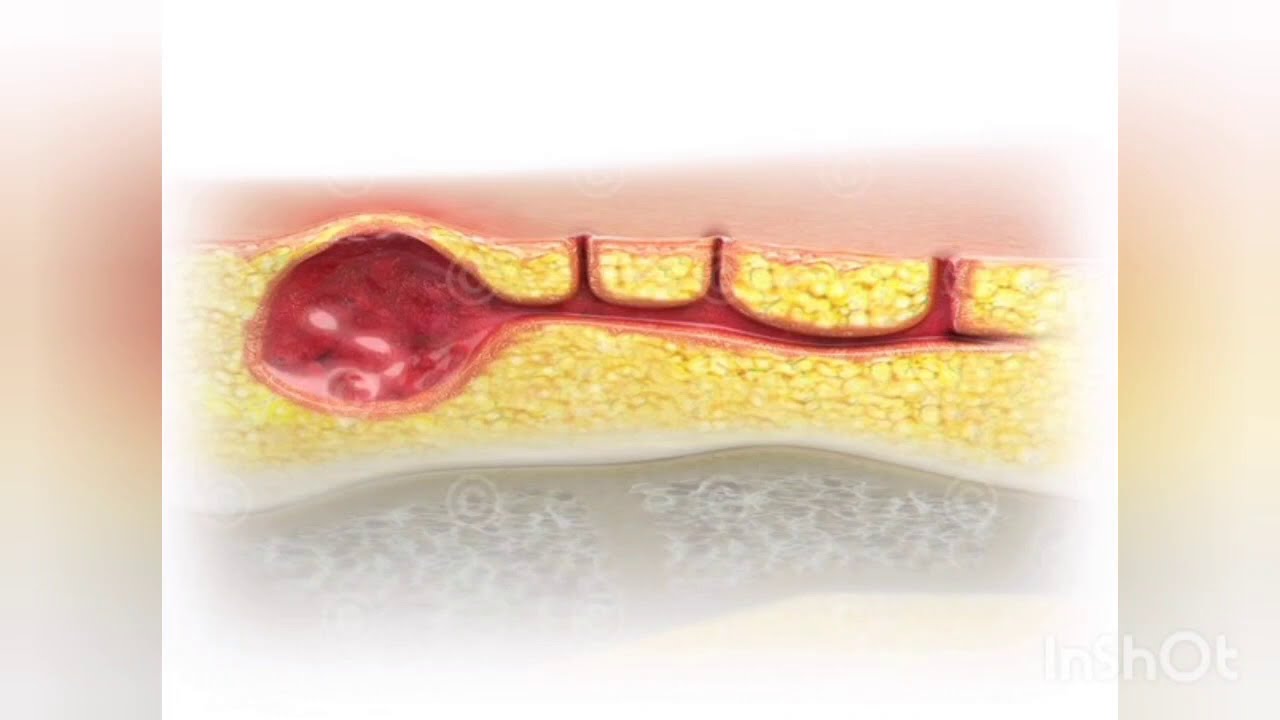 Шишка возле копчика. Шишка между ягодиц. Эпителиальный копчиковый ход ...