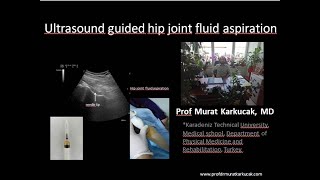 Ultrasound Guided Hip Joint Fluid Aspiration
