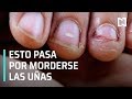 Riesgos por morderse las uñas - En Punto