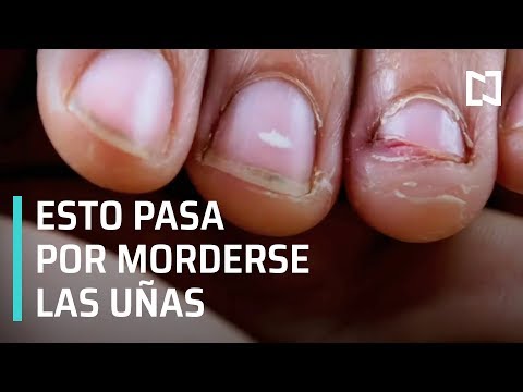 Video: ¿Qué es morderse las uñas?