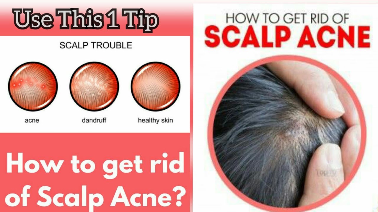 Share more than 72 pimple on head under hair latest - in.eteachers