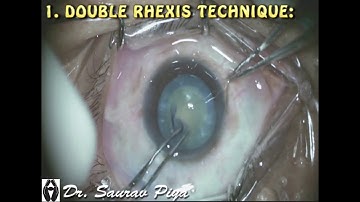 TECHNIQUES TO PREVENT  "ARGENTINIAN FLAG SIGN" IN HYPERMATURE INTUMESCENT CATARACT - Dr. Saurav Piya