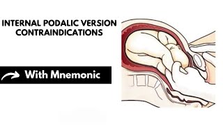 Internal Podalic Version Contraindications With Mnemonic | Obstetrics Mnemonics | Dr Mubashar Ata screenshot 5