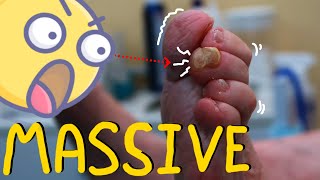 MASSIVE Toe Corn Removal! Satisfying &amp; Painless