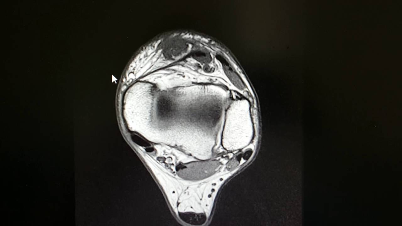 Anterior Tibial Tendon Rupture As Seen On An Mri Youtube