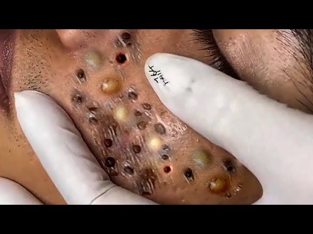 角栓除去】超絶変化！大量のニキビを芯出しするって気持ちいい