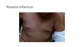 Roseola Infantum by House Job 9 views 1 month ago 6 minutes, 7 seconds