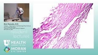 Glaucoma Pathology [ARCHIVE]