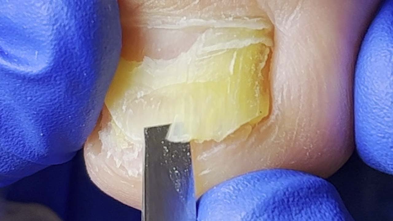 Pedicure Tutorial The Complete Trimming Process for Thick Nails!【Xue